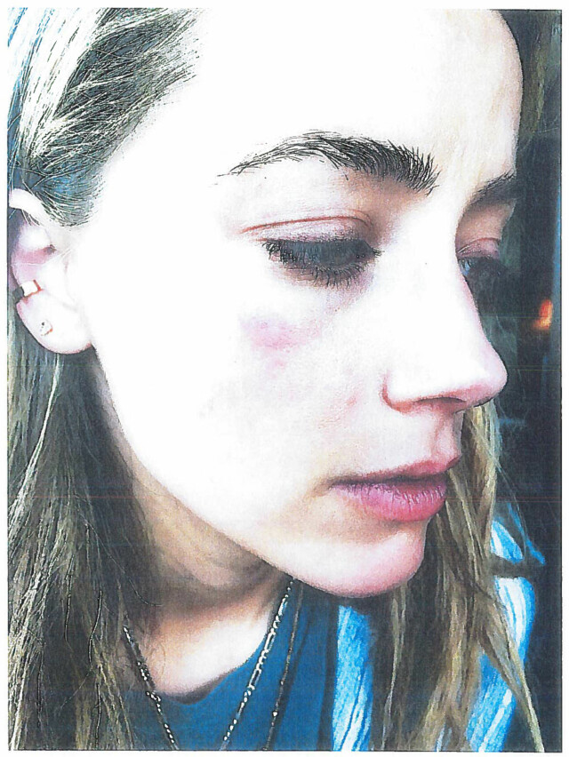 FORSLÅTT: Amber Heard la frem dette bildet med blåveis som bevis, som hun hevdet var et resultat av Johnny Depps fysiske mishandling. Foto: Reuters FORSLÅTT: Amber Heard la frem dette bildet med blåveis som bevis, som hun hevdet var et resultat av Johnny Depps fysiske mishandling. Foto: Reuters